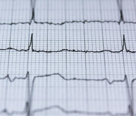 Courbe électrocardigramme